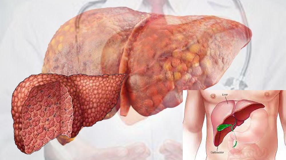 कलेजो सुस्तै बिगार्ने रोग - लिभर सिरोसिस : कारण, लक्षण र रोकथाम